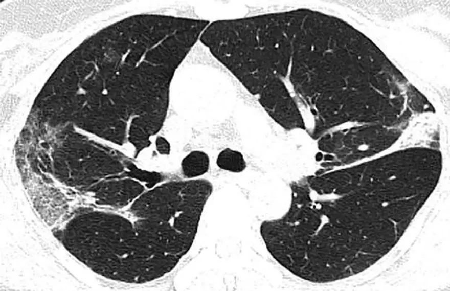 44yaşında corona virüsten hayatını kaybeden kişinin  akciğer röntgen filmleri virüsün verdiği zararıortaya çıkardı 