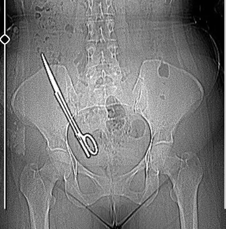 Karnında makas unutuldu,  7 yıl sonra böyle ortaya çıktı: "Mucize eseri hayatta kalmışım" 3