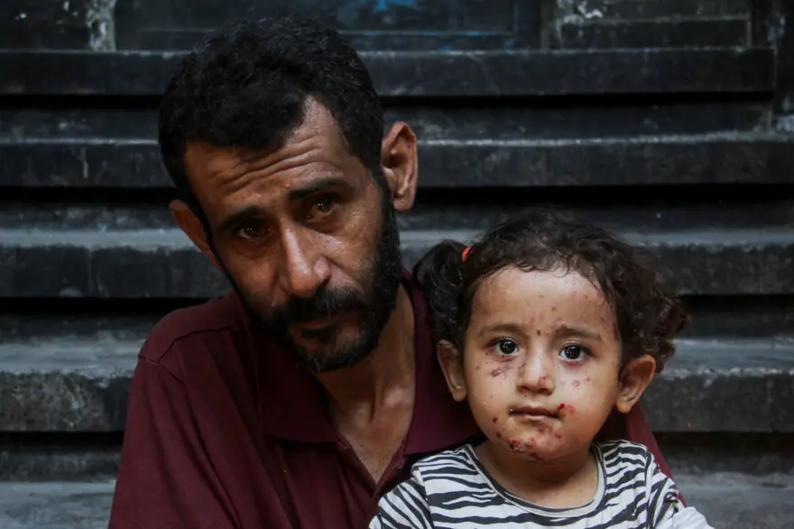 ÇOCUKLAR CİLT ENFEKSİYONLARIYLA BOĞUŞUYOR ÇOCUKLAR CİLT ENFEKSİYONLARIYLA BOĞUŞUYOR