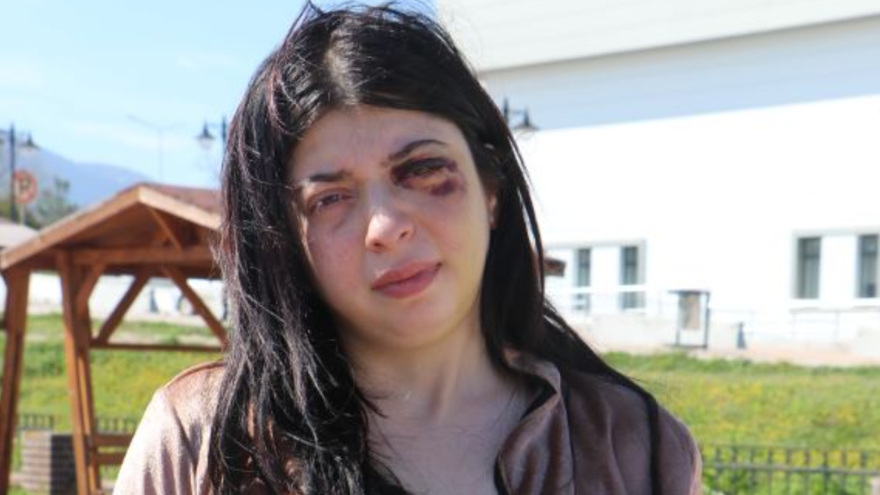 Sokak ortasında önce sözlü taciz sonra saldırı: Damla üç ay sadecesıvıyla beslenecek 1 Sokak ortasında önce sözlü taciz sonra saldırı: Damla üç ay sadecesıvıyla beslenecek 1