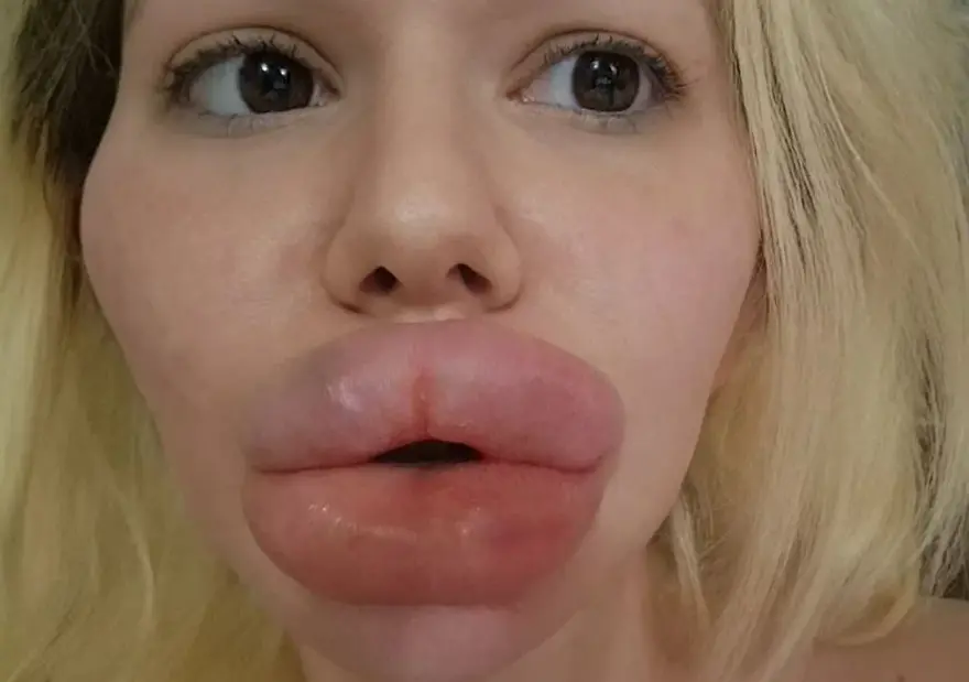 Dünyanın en büyük dudaklı kadını: Sağlık çalışanları onu tedavi etmeyi reddediyor 2