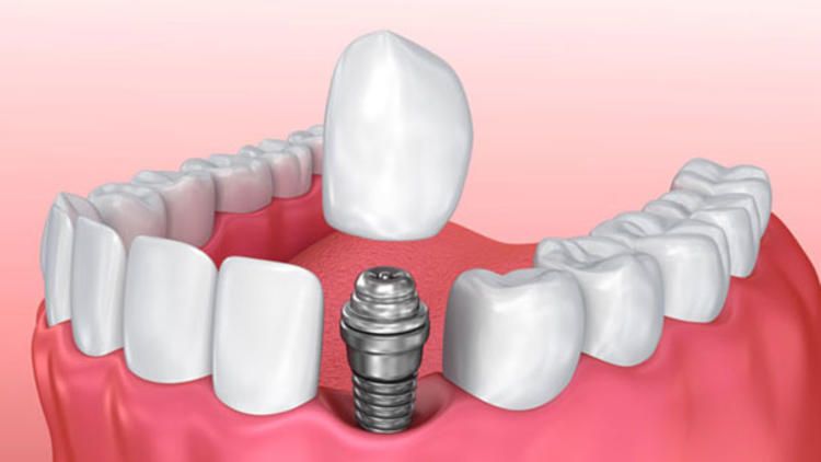 “Diş fırçalamak yerine implant yaptırıyoruz”