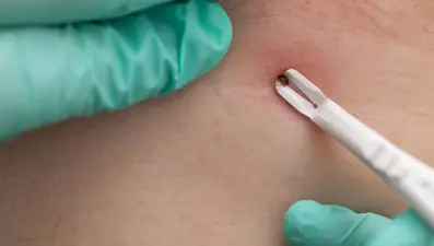 Bir ilde kene uyarısı: Bu belirtilere dikkat!