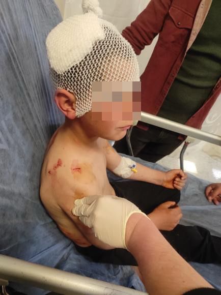 Isparta'ta başıboş sokak köpeği saldırısı: 9 yaşındaki çocuk ölümden döndü