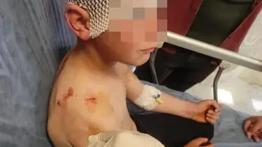 Isparta'ta başıboş sokak köpeği saldırısı: 9 yaşındaki çocuk ölümden döndü