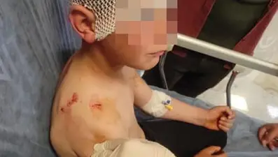 Isparta'ta başıboş sokak köpeği saldırısı: 9 yaşındaki çocuk ölümden döndü