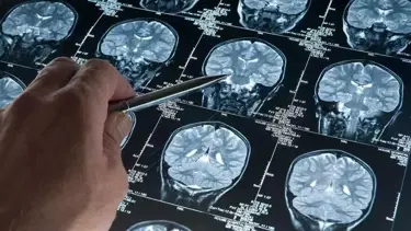 Alzheimer araştırmalarında yeni keşif: Riski artıran genetik varyant bulundu