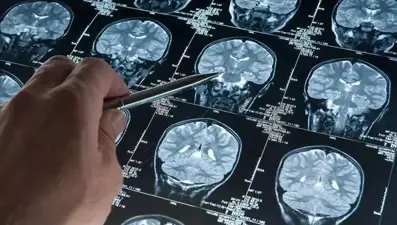 Alzheimer teşhisinde kan testi umudu