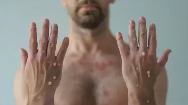 DSÖ: Dünya genelinde 90 binden fazla maymun çiçeği virüsü vakası görüldü