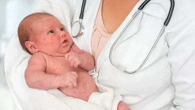 Kızamık nedir, belirtileri nelerdir? (Kızamık nasıl ortaya çıkar ve nasıl tedavi edilir?)