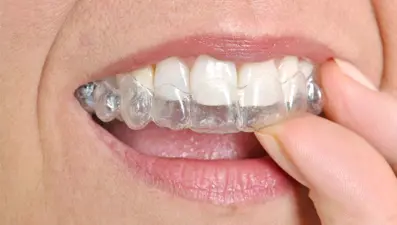 Şeffaf plak tedavisi nedir, avantajları nelerdir?