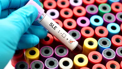 Kelebek hastalığı (lupus) neden olur, belirtileri nelerdir? Kelebek hastalığı nasıl tedavi edilir?