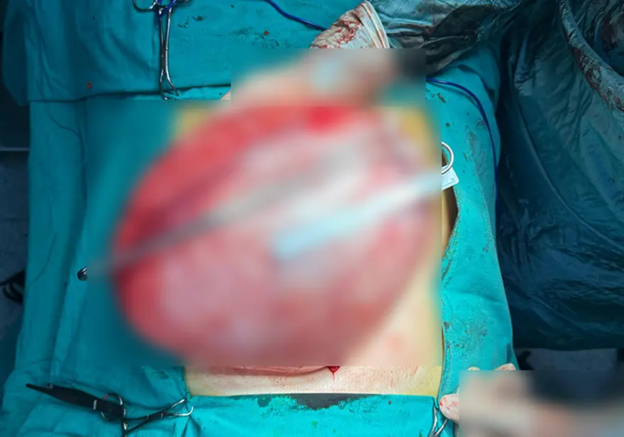 Kilolarından kurtulmak için doktora gitti. Karnından çıkan şoke etti 2