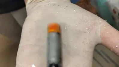 39 yaşında pil yuttu, midesinden çıkarıldı: Nadir örneklerden biri