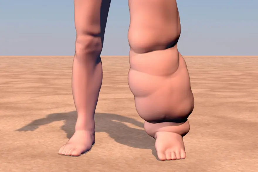 FİL AYAĞI HASTALIĞI BELİRTİLERİ 2