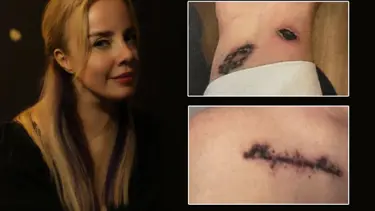 Estetik merkezinde kabus! "Dövme sildirmek için gittim az kalsın sakat kalıyordum"