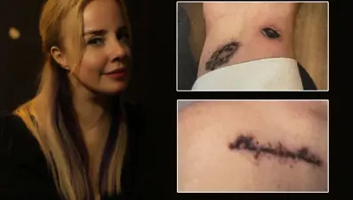 Estetik merkezinde kabus! "Dövme sildirmek için gittim az kalsın sakat kalıyordum"