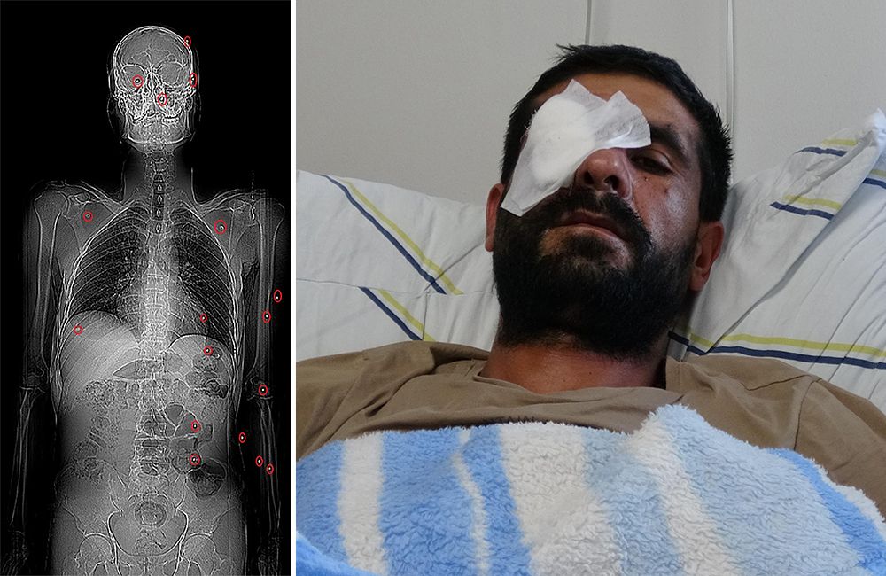 Hasımları pusu kurdu, bir gözünü kaybetti (Vücudunda 32 saçmayla yaşıyor)
