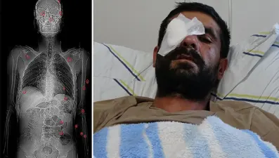 Hasımları pusu kurdu, bir gözünü kaybetti (Vücudunda 32 saçmayla yaşıyor)