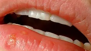 Dudakta uçuk çıkmasının nedenleri nelerdir? Uçuk nasıl geçer?