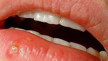 Dudakta uçuk çıkmasının nedenleri nelerdir? Uçuk nasıl geçer?