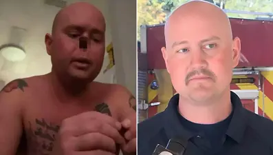 Milyonda 2 kişide görülüyor: Grip oldu, burnunu kaybetti