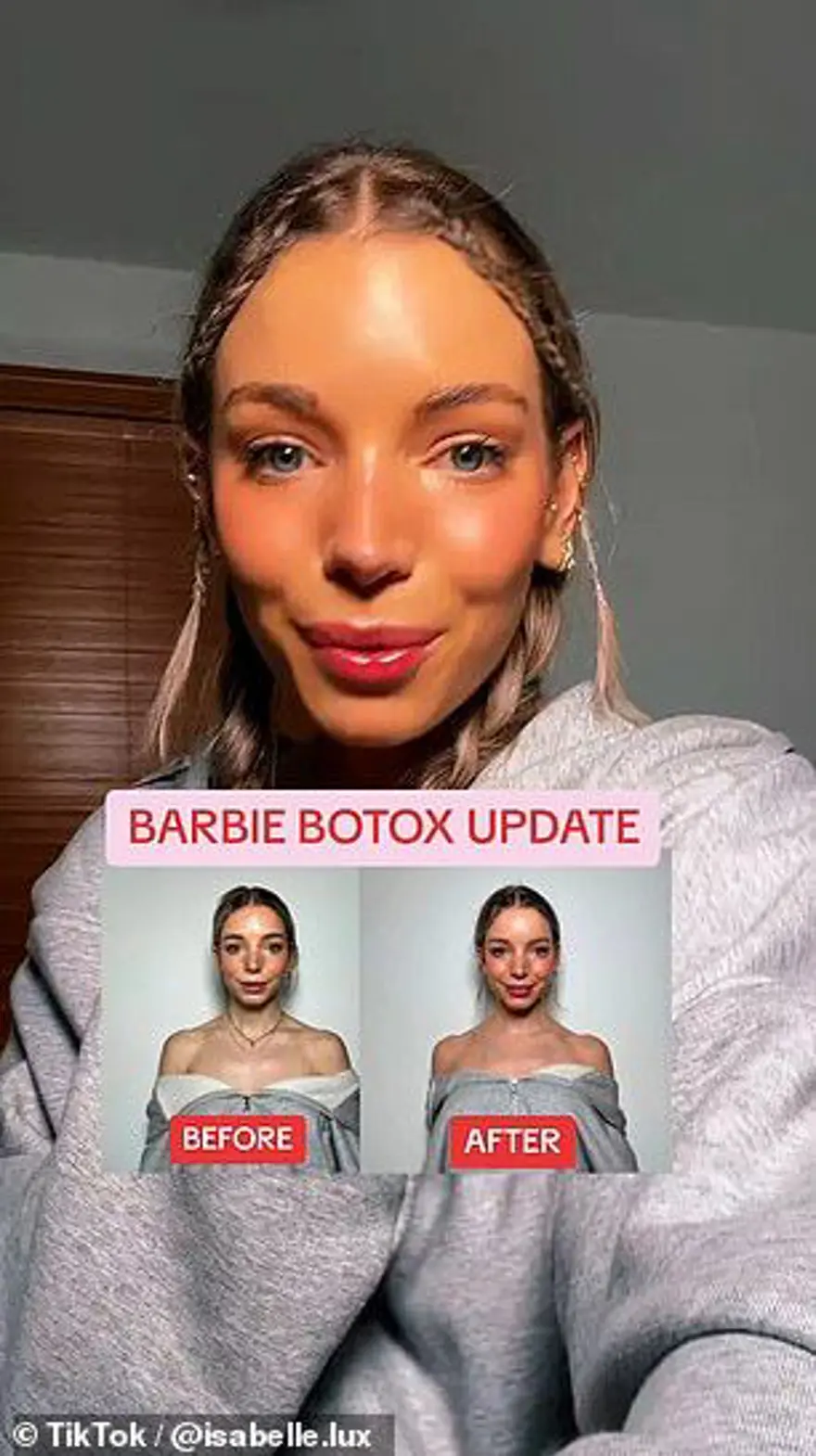Yükselen trend: Barbie botoksu 2