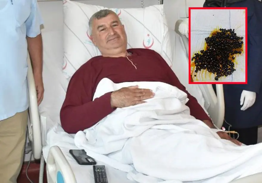 Doktorlar bile şaşırdı: Hepsi safra kesesinden çıkarıldı 