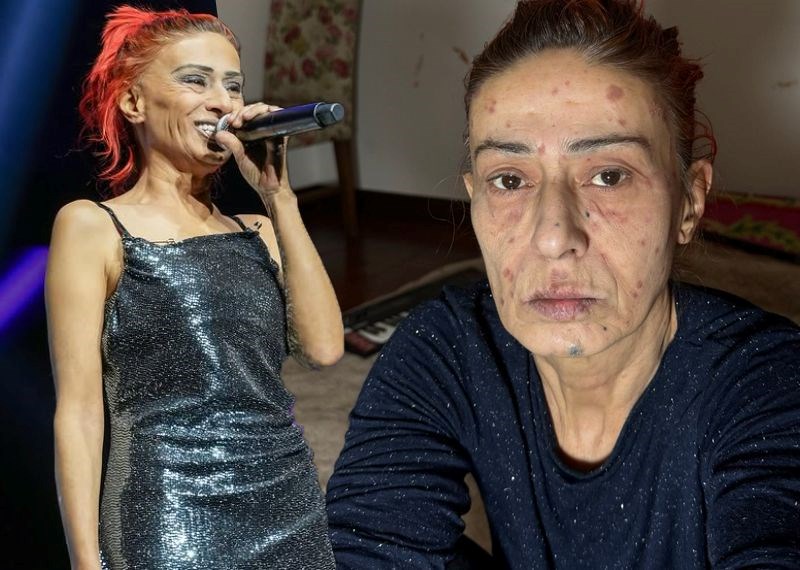 Yıldız Tilbe'nin yüzünde yanıklar oluşmuştu: Son durumunu açıkladı