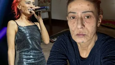 Yıldız Tilbe'nin yüzünde yanıklar oluşmuştu: Son durumunu açıkladı