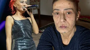 Yıldız Tilbe'nin yüzünde yanıklar oluşmuştu: Son durumunu açıkladı