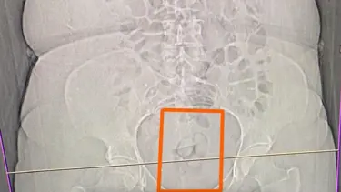 Midesinden metamfetamin çıktı