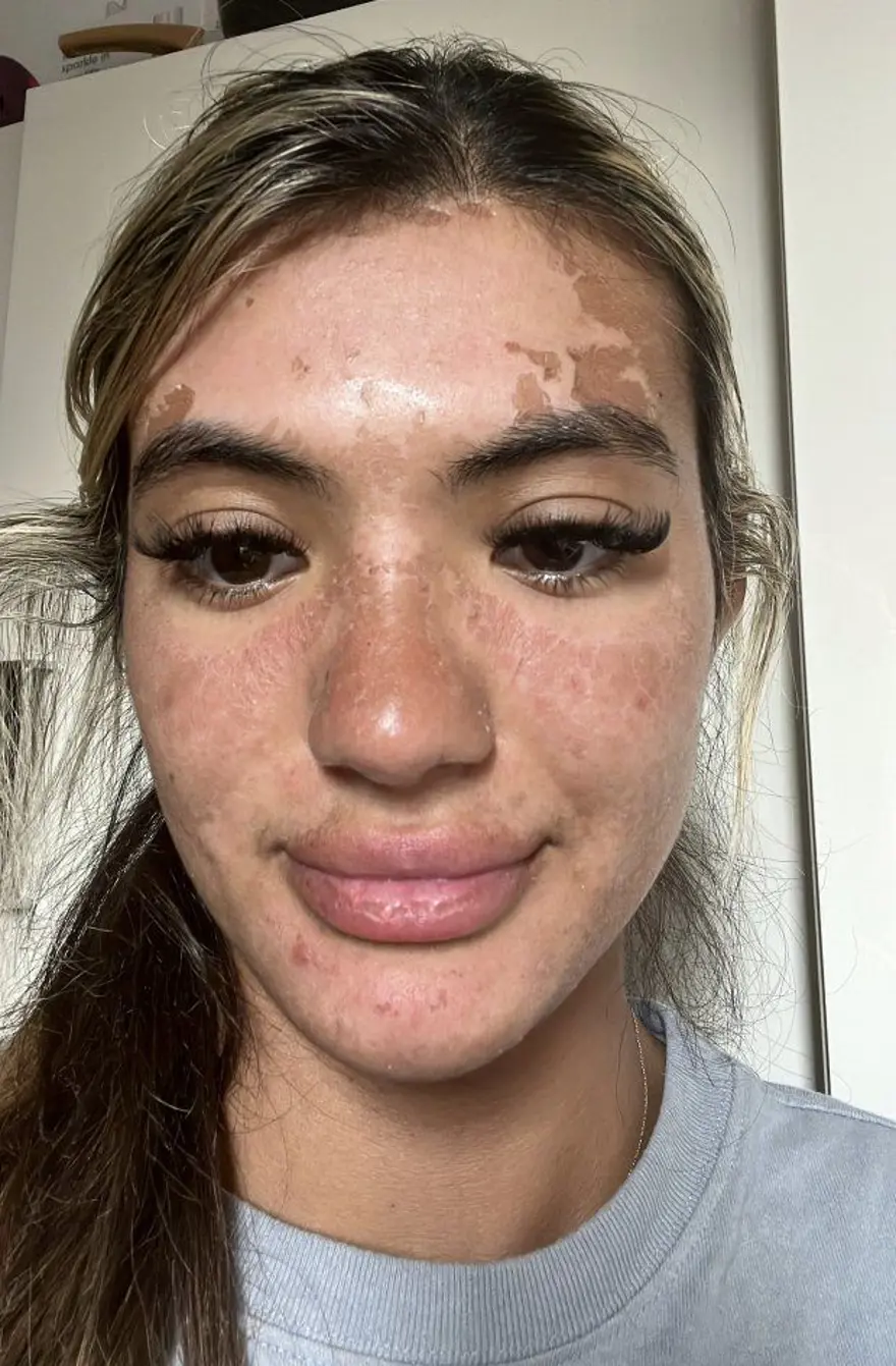 Uzmanlar güneş ışınlarına karşı uyardı: Havuz başında uyuyakalan kadın Star Trek karakterine benzetildi 3