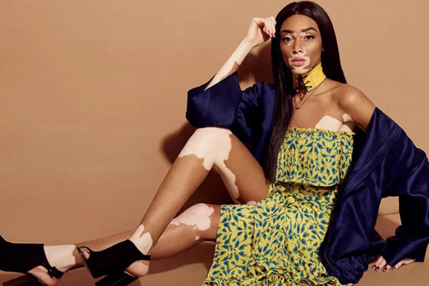 Vitiligolu model Winnie Harlow: Sizin gibi beynim ve iskeletim var 5