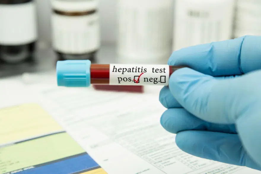 Çocuklardaki gizemli hepatit hastalığı ile ilgili bilinmesi gereken her şey (Gizemli hepatit hastalığının belirtileri nelerdir?) 4