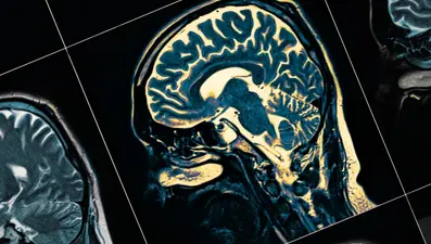 Nörologlar açıkladı: Bu 2 mesleği yapanların Alzheimer'a yakalanma riski çok düşük