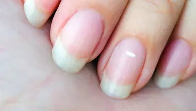 Tırnaklarınızı hemen kontrol edin: Kalp ve karaciğer hastalığının sinyali