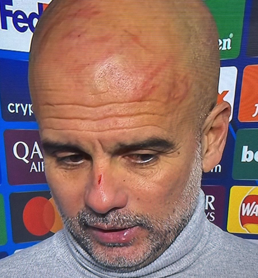 6 maçtır kazanamayan Manchester City'de Guardiola'nın yüzündeki çizikler dikkat çekti: Kendime zarar vermek istedim 3