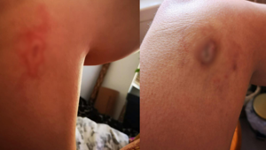 Telefon şarjdayken uyuyakaldı, sabah yanıkla uyandı! "Keşke bu kadar tehlikeli olduğunu bilseydim" Telefon şarjdayken uyuyakaldı, sabah yanıkla uyandı! "Keşke bu kadar tehlikeli olduğunu bilseydim"