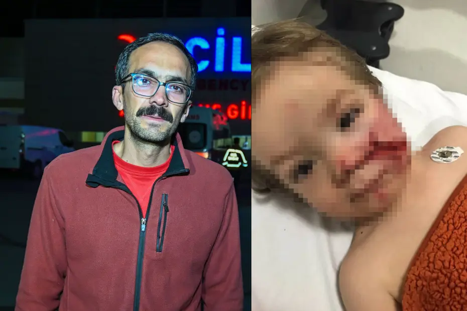 Başkentte pitbull dehşeti. İki kardeş yaralandı, birinin yüzü parçalandı