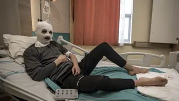 Çakmak gazı tüpü elinde patladı. Bütün yüzü ve göğsü yandı