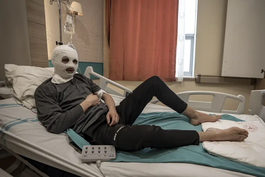 Çakmak gazı tüpü elinde patladı. Bütün yüzü ve göğsü yandı