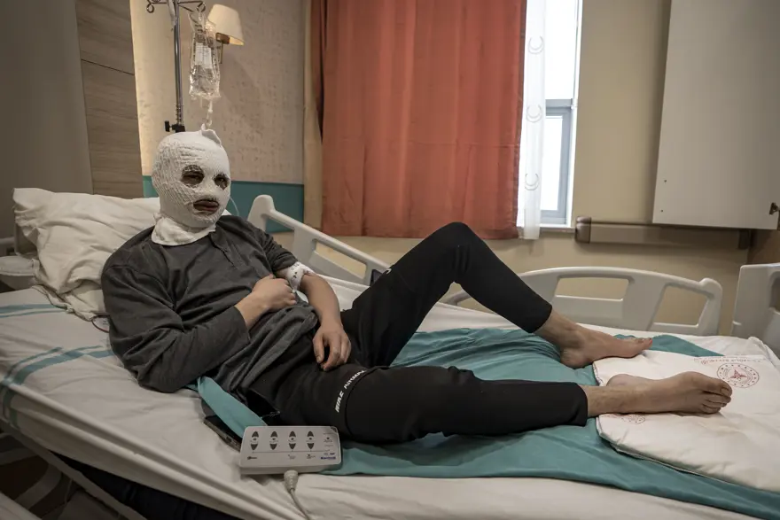 Çakmak gazı tüpü elinde patladı. Bütün yüzü ve göğsü yandı Çakmak gazı tüpü elinde patladı. Bütün yüzü ve göğsü yandı