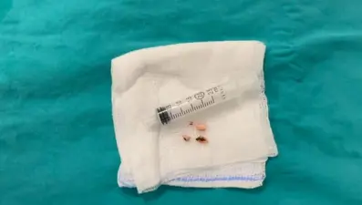 Akciğerine ceviz parçaları kaçtı, 10 gün yoğun bakımda kaldı  