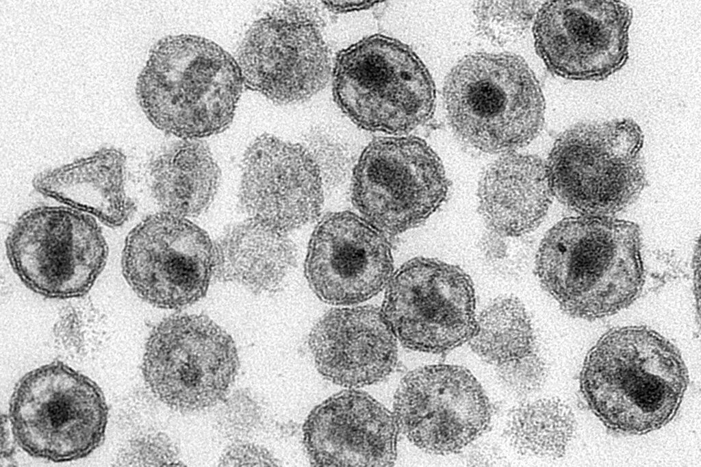 Dünyada 40 milyon 800 bin kişi HIV virüsü taşıyor