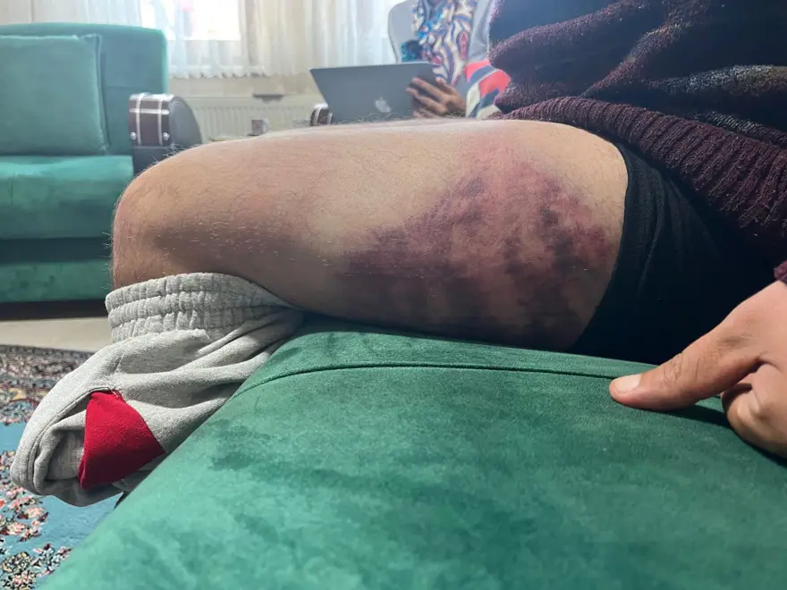 Otizmli bir kişiyi "odunluğa baktı" diye dövdüler 5