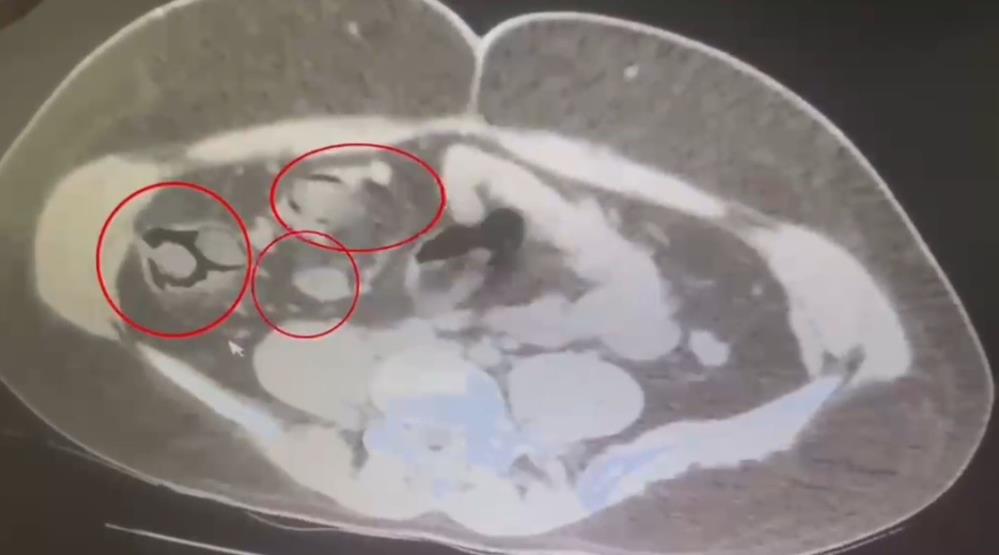Yolcu otobüsünde yakalandı: İranlı kurye midesine saklamış!