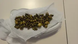 77 yaşındaki kadının safra kesesinden çıkarıldı: Tam 213 adet