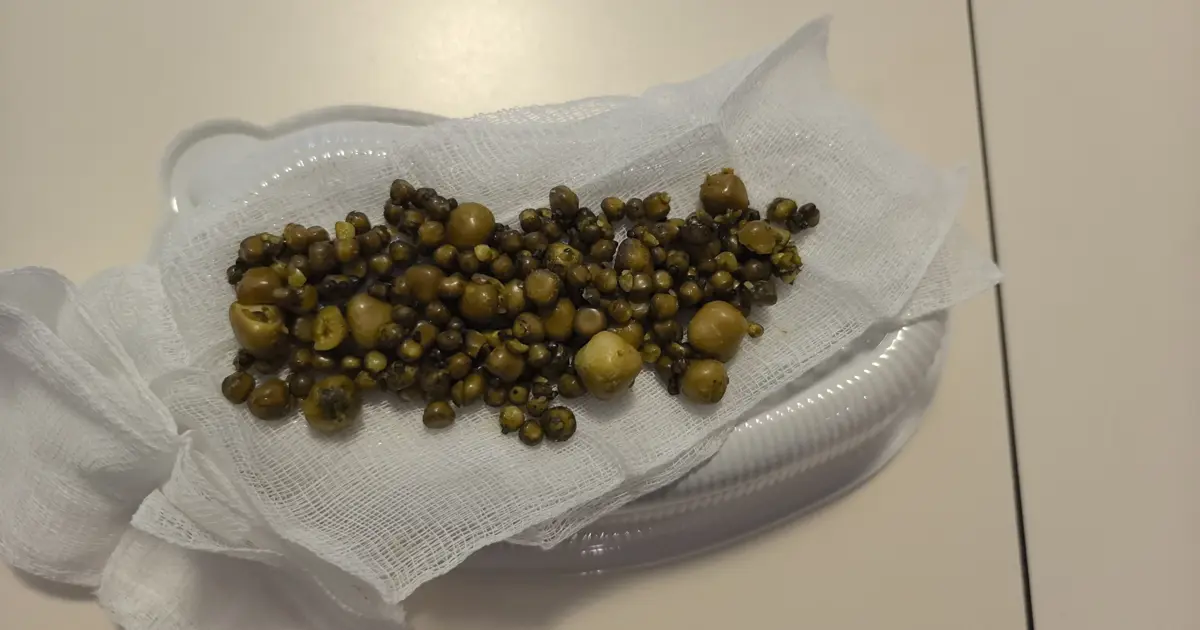 77 yaşındaki kadının safra kesesinden çıkarıldı: Tam 213 adet