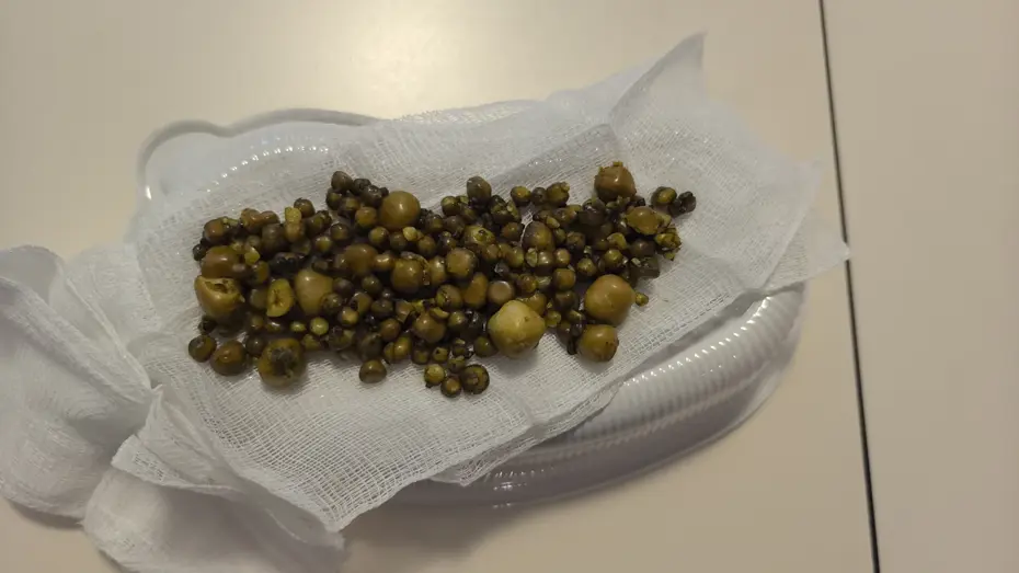 77 yaşındaki kadının safra kesesinden çıkarıldı: Tam 213 adet